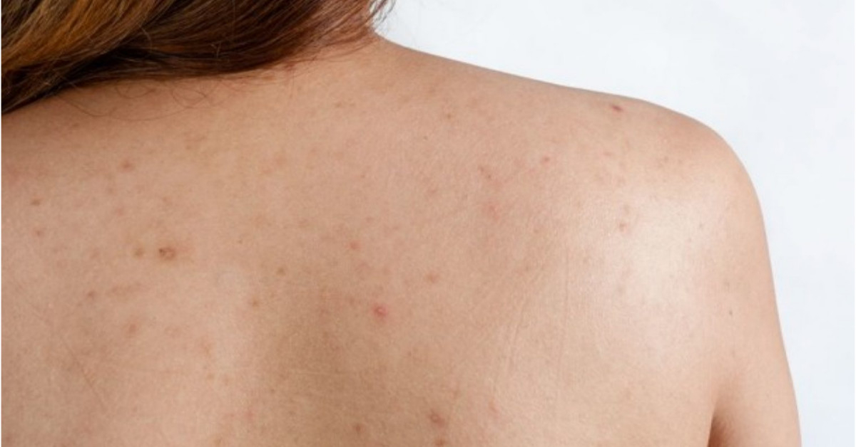 Tình trạng mụn lưng mức độ nhẹ với các nốt mụn rải rác