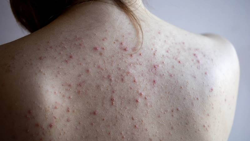 Mụn lưng viêm đỏ và mụn mủ lan rộng trên vùng lưng