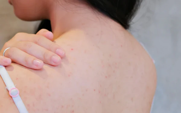 Hình ảnh minh họa điều trị mụn lưng bằng phương pháp chuyên sâu